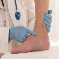 علاج و دواء دوالي الساقين بالليمون Varicose veins