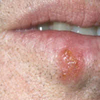 طرق ووسائل علاج و دواء الهربس Herpes بالأعشاب