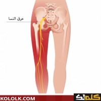 تمارين لعلاج و دواء عرق النسا عند الرجال والنساء