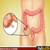 هل تعود مره اخرى الزائدة الدودية بعد عملية استئصالها