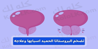 تضخم البروستاتا الحميد اسبابها وعلاجه .. دور الليزر في علاج البروستاتا