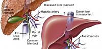 طريقة عملية زراعة الكبد