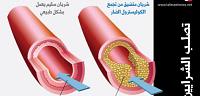 تعرف على ما هى نسبة الكوليسترول الطبيعية