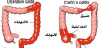 طريقة علاج و دواء مرض كرون