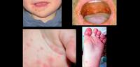 تعرف ما هو مرض اليد-القدم-الفم
