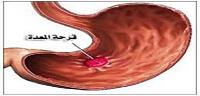 كيف تعالج قرحة المعدة