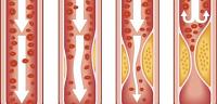 تعرف ما هو مرض تصلب الشرايين