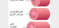 تعرف ما هو علاج و دواء تصلب الشرايين